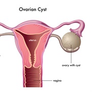 Polycystic Ovarian Disease