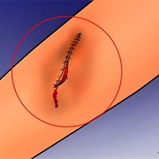 Stitch a Gaping Wound