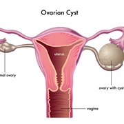 Ovarian Cyst