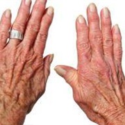 Arthritis