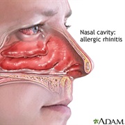 Allergic Rhinitis