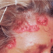 Sarcoidosis Awareness Month (April)