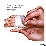 Soothe a 1st Degree Burn