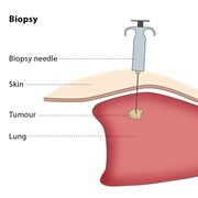 Biopsy