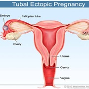 Fallopian Pregnancy