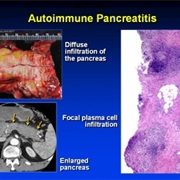 Autoimmune Pancreatitis