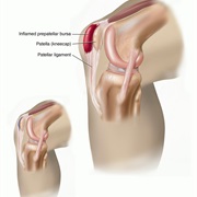 Bursitis