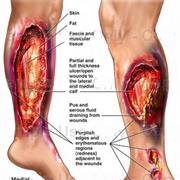 Necrotizing Fasciitis