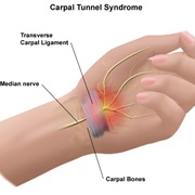 Treat Carpal Tunnel Syndrome