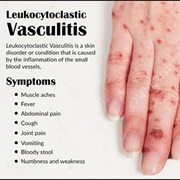 Leukocytoclastic Vasculitis