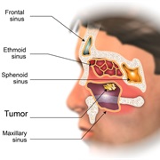 Nasal and Sinus Cancer