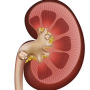 Kidney Stones