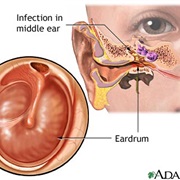 Middle Ear Infection