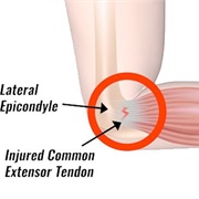 Tennis Elbow