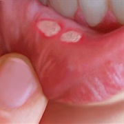 Canker Sore