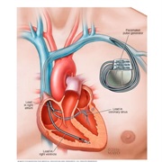 Congenital Heart Block