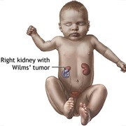Wilms' Tumor