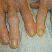 Osteoarthritis