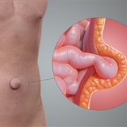 Umbilical Hernia