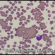 Cold Agglutinin Disease