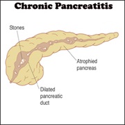 Chronic Pancreatitis