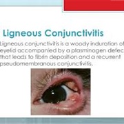 Ligneous Conjunctivitis