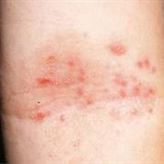 Atopic Eczema