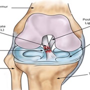 ACL Tear