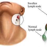 Swollen Glands