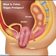 Pelvic Organ Prolapse