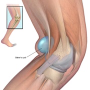 Baker's Cyst