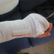 Broken Bone