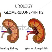 Glomerulonephritis