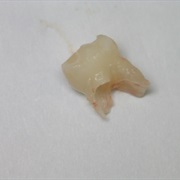Knocked-Out Tooth