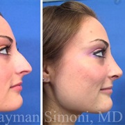 Rhinoplasty (Nose Job)