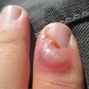 Ingrown Fingernail