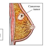 Breast Tumor