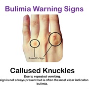 Bulimia