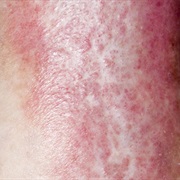 Varicose Eczema