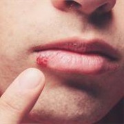 Cold Sore