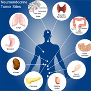Neuroendocrine Tumours (Nets)