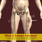 Ewings Sarcoma