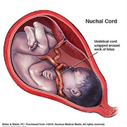 Nuchal Cord