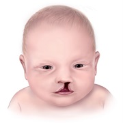 Cleft Lip