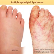 Antiphospholipid Syndrome