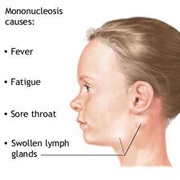 Glandular Fever (Infectious Mononucleosis)