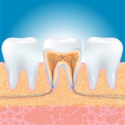 Root Canal Treatment