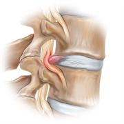 Herniated Disc