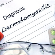 Dermatomyositis