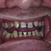 Poor Dental Spacing